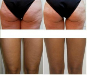 One simple anti-cellulite treatment and the aftercare - RECOVA®