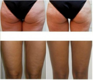 Cellulite Treatment Before-and-After Photos