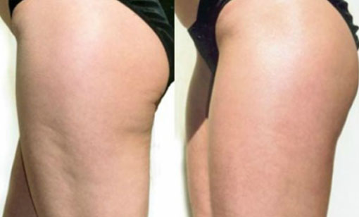 Female Hips & Thighs - Elite Body Contouring in Northern Virginia