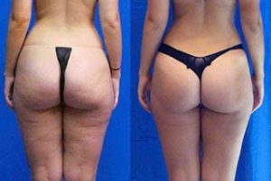 Cellulite Reduction Arlington