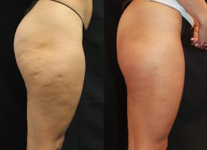 What Treatment Can I Get to Reduce Cellulite