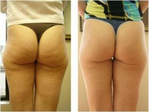 Exilis Cellulite Treatment  Reduce Cellulite in Virginia