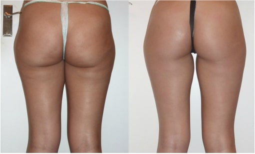 Female Hips & Thighs - Elite Body Contouring in Northern Virginia