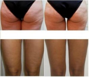 Best Non-Surgical Cellulite Reduction, Venus Legacy