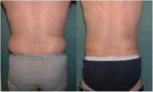 9134193 love handles