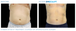 Noninvasive Body Sculpting in Northern Virginia