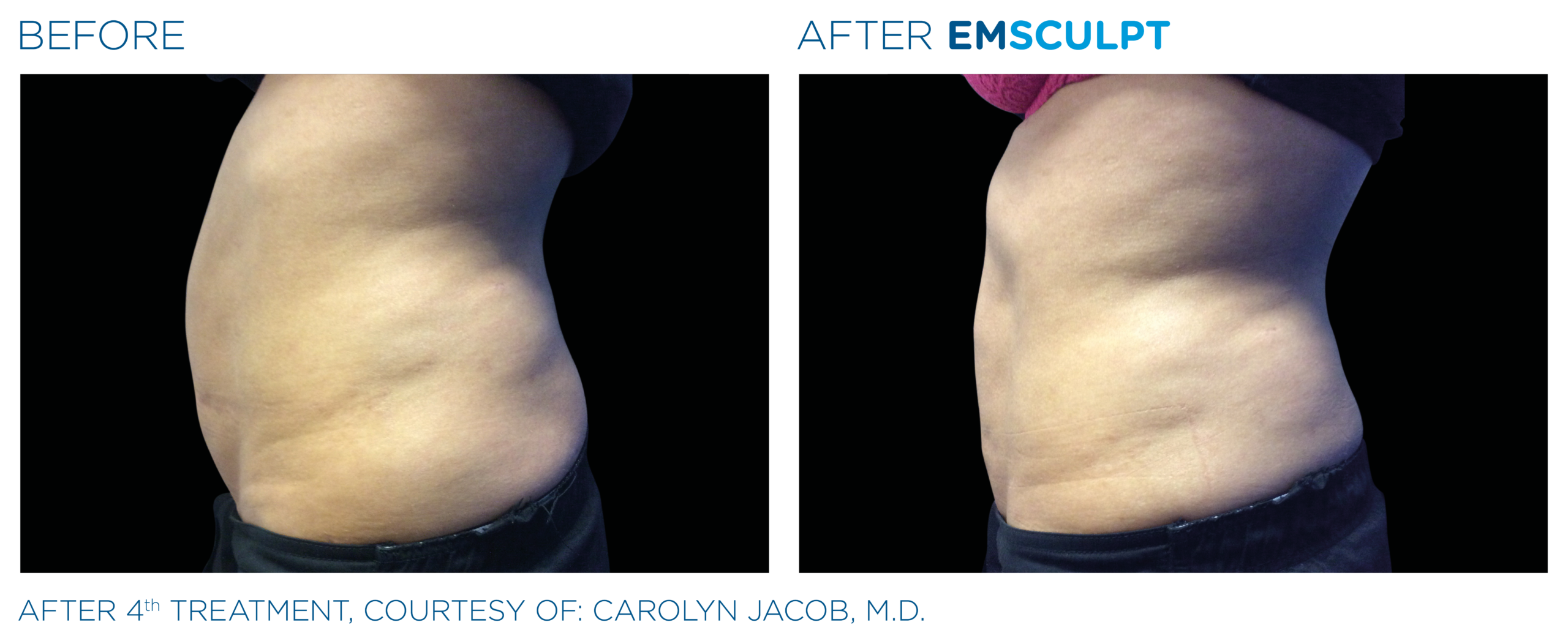 emsculpt northern virginia
