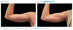 emsculpt arms northern virginia