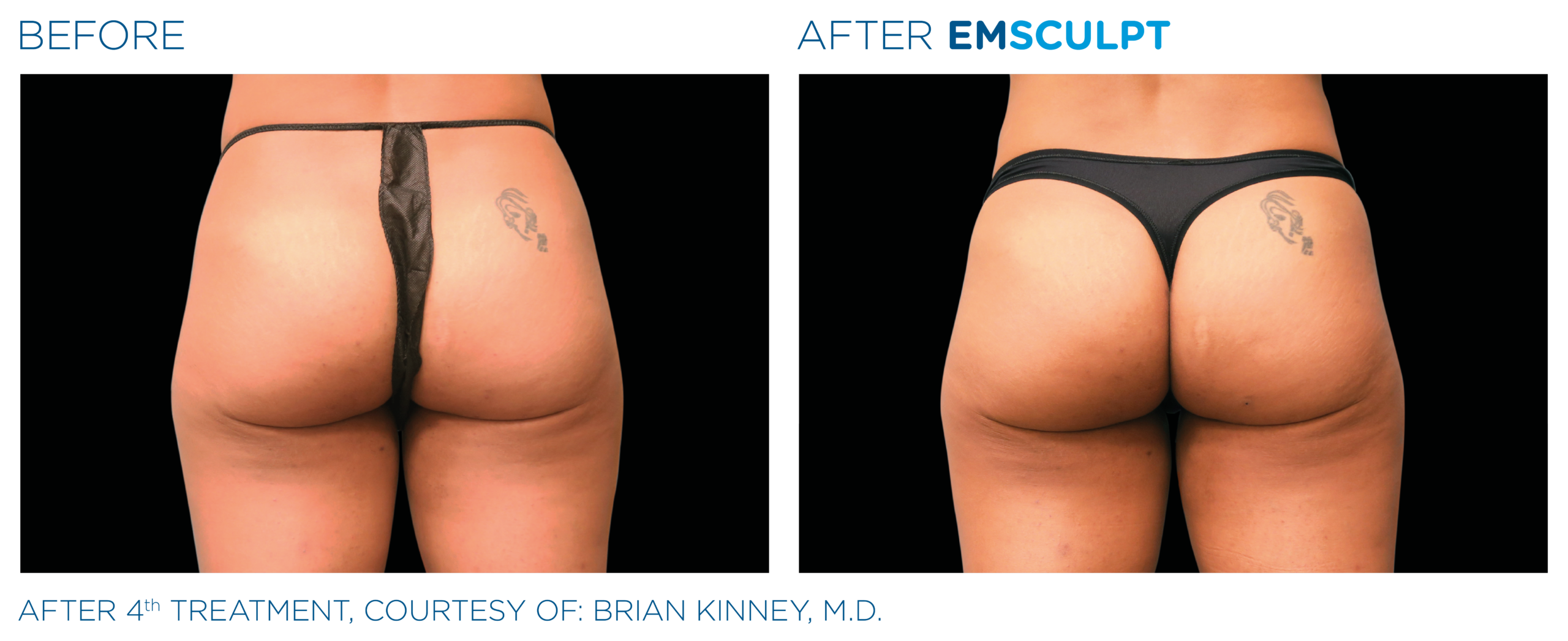 emsculpt rosslyn