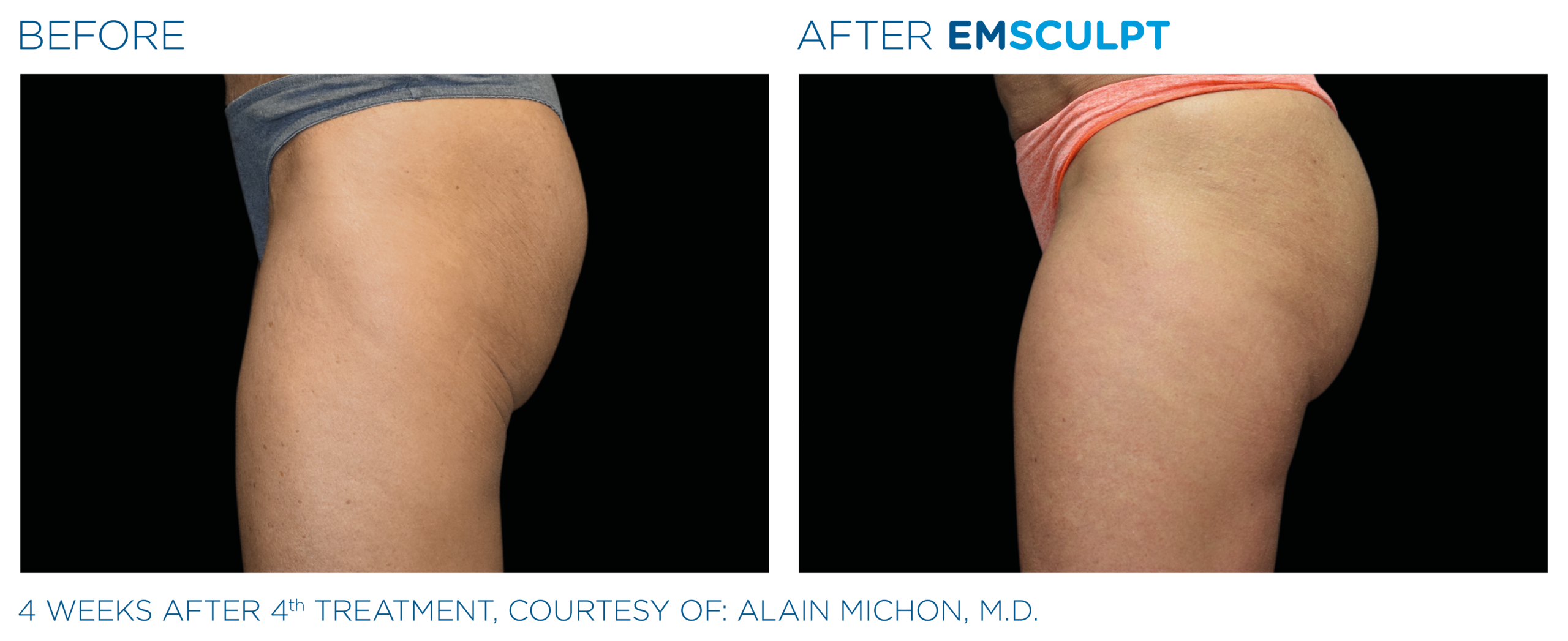 emsculpt washington dc