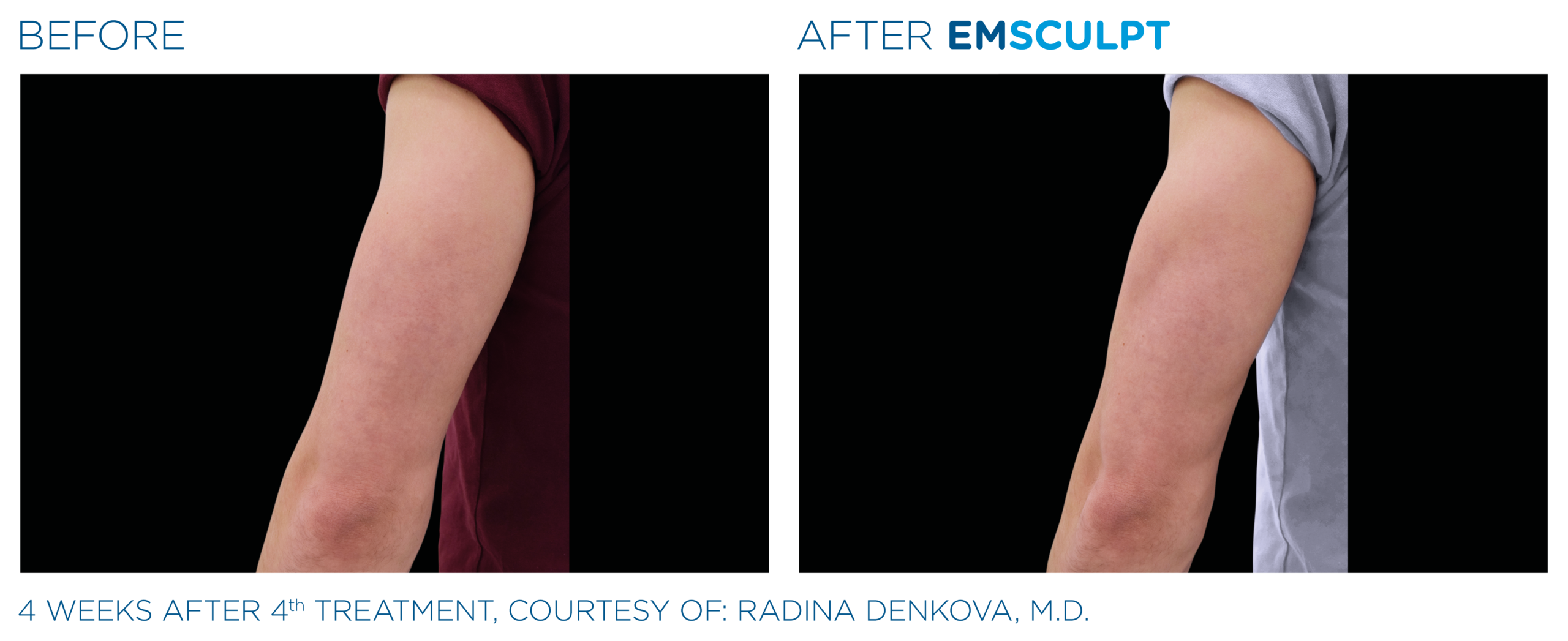 emsculpt arms arlington