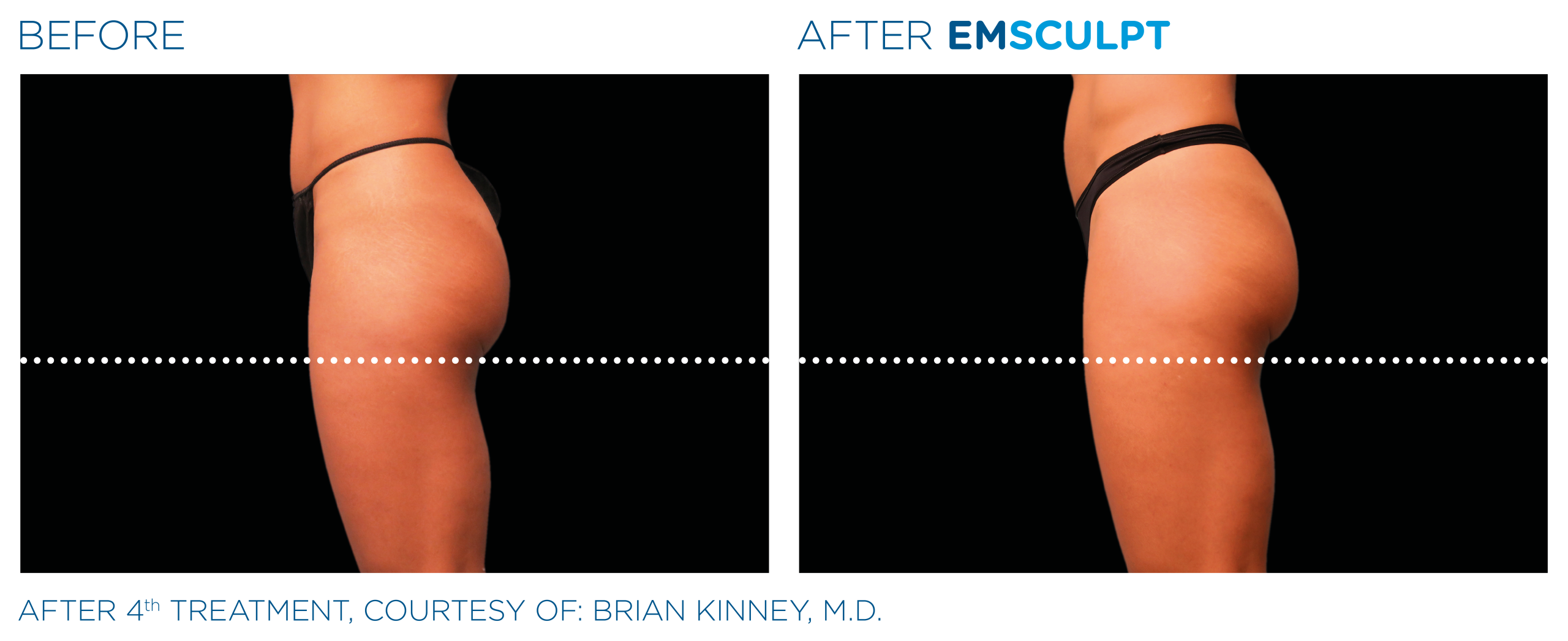 emsculpt butt lift mclean