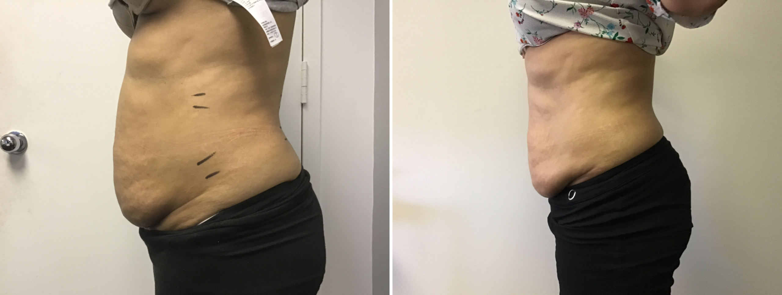 noninvasive body contouring washington dc