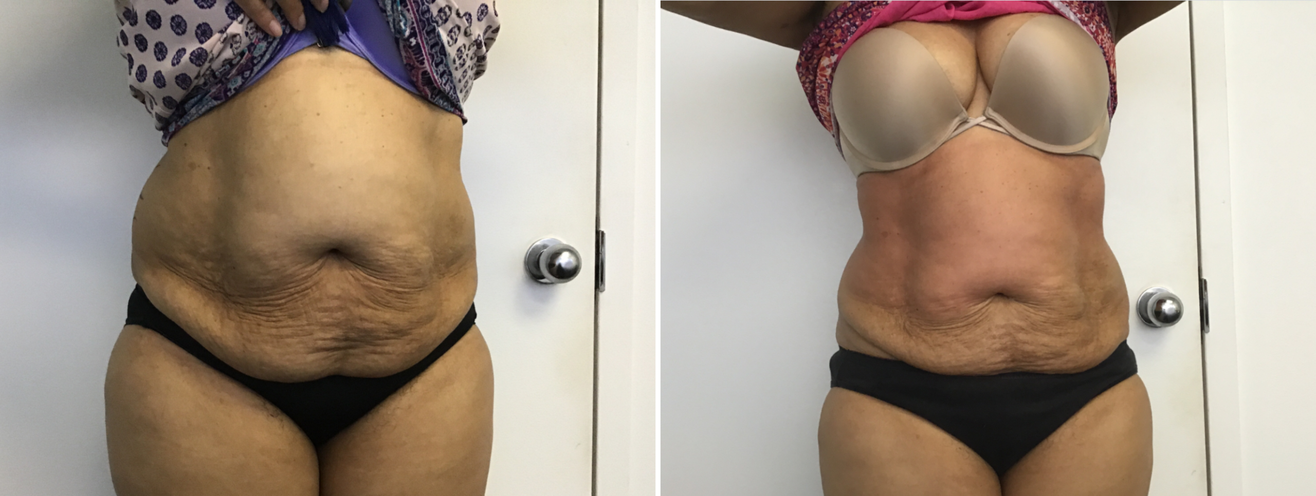 fat reduction arlington