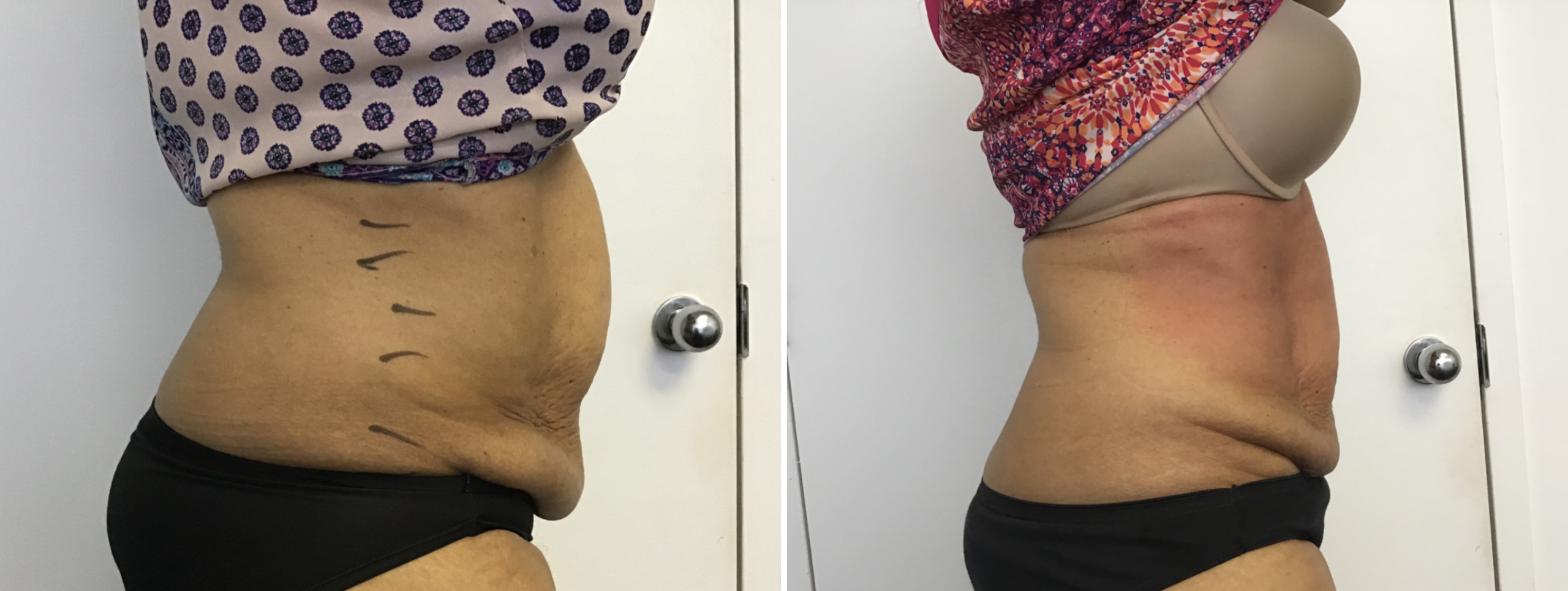 fat reduction rosslyn