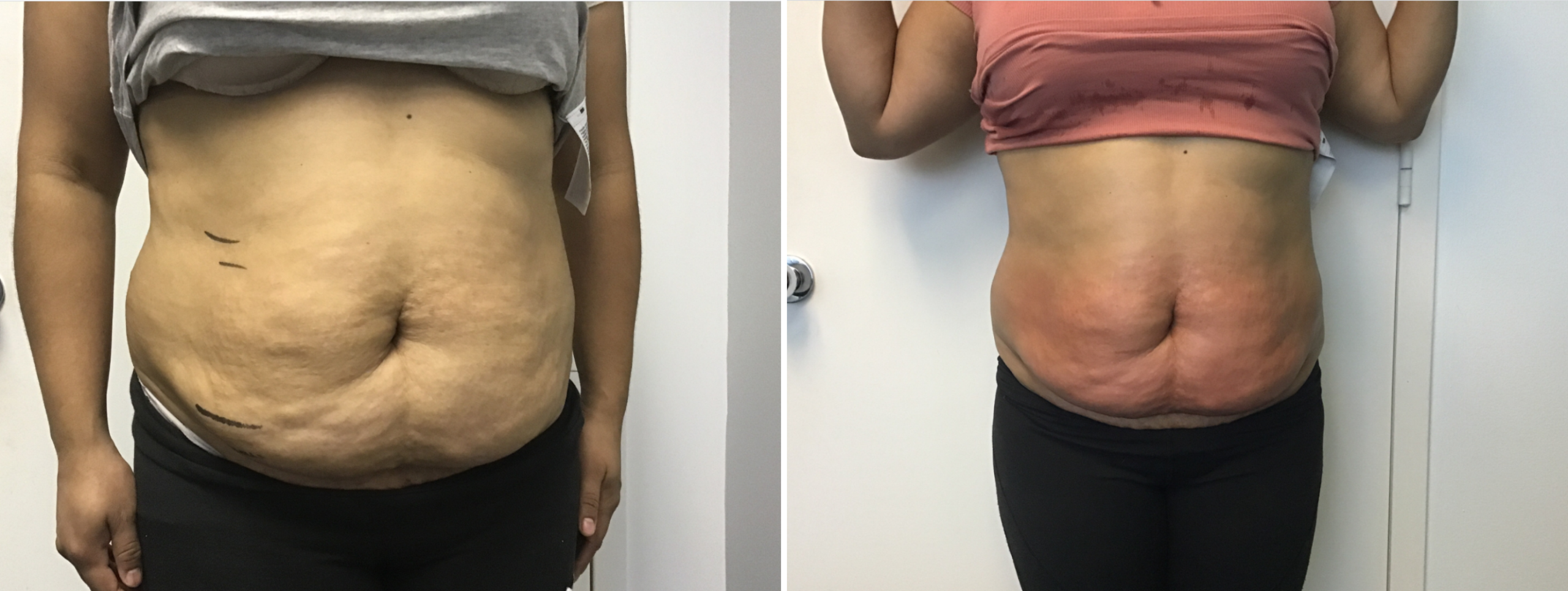 fat reduction washington dc