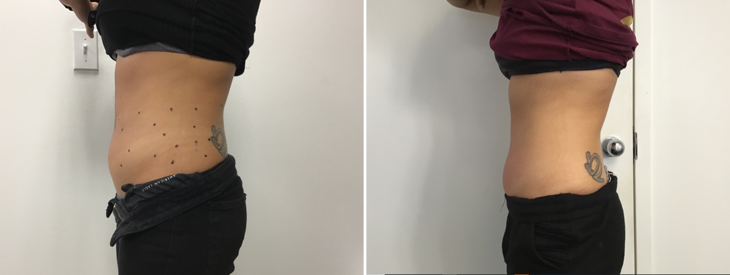 noninvasive body contouring northern virginia