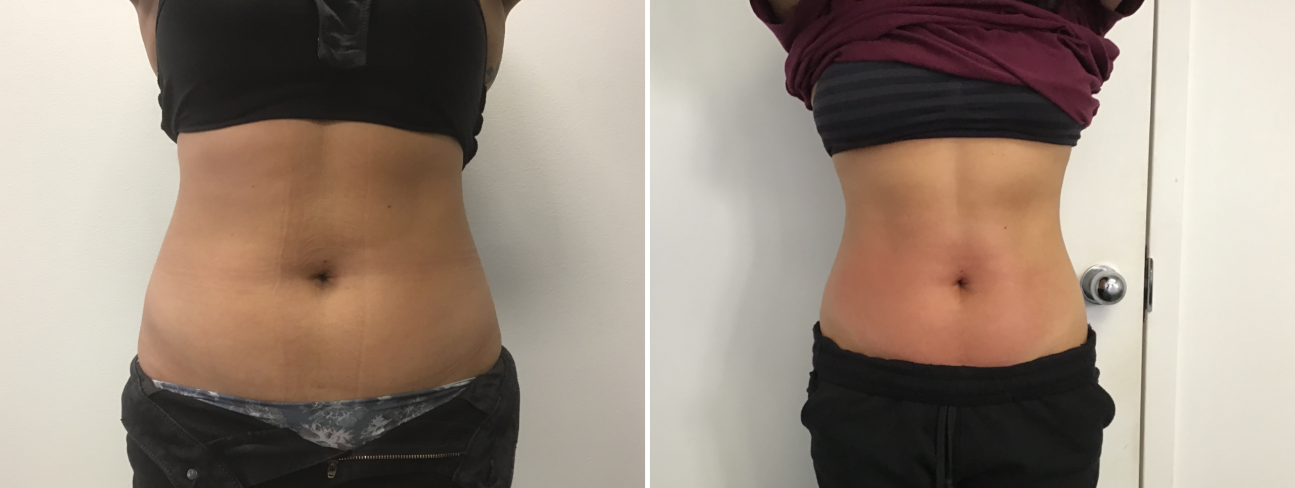 noninvasive body contouring arlington