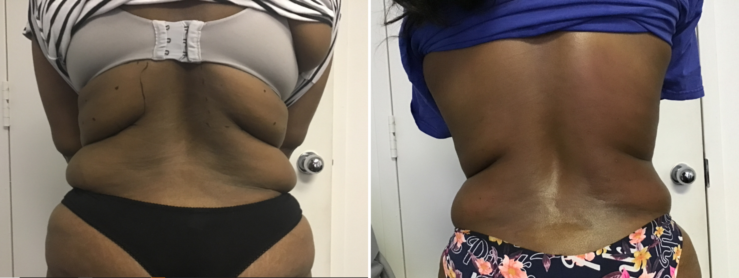 Back Fat Reduction Arlington