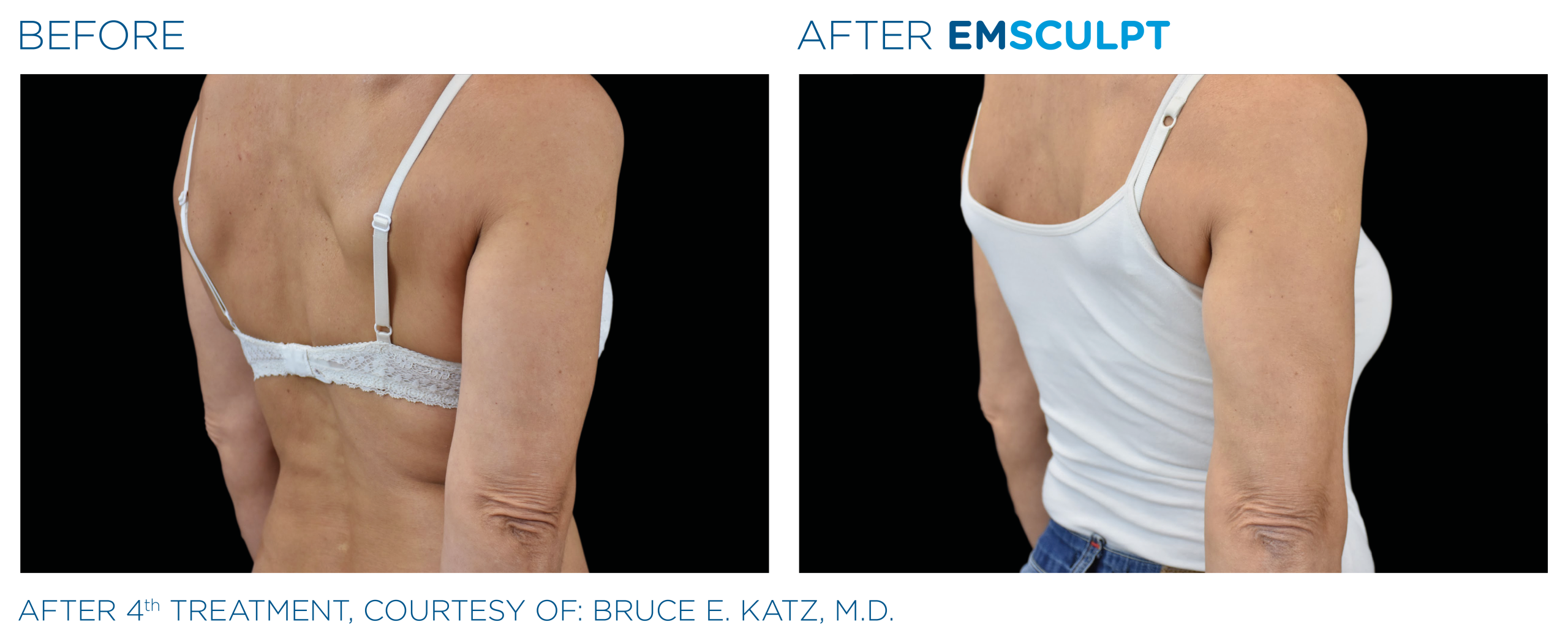 emsculpt for biceps
