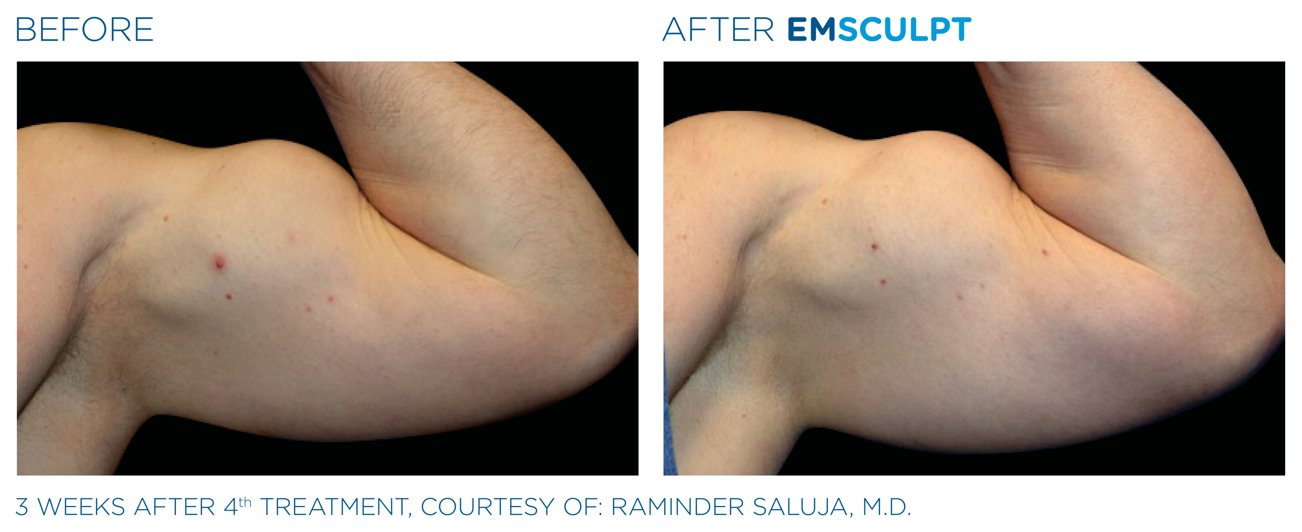 emsculpt northern virginia