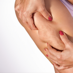 cellulite removal in northern virginia with Venus Bliss