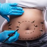emsculpt liposuction arlington