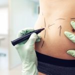 risks tummy tuck arlington