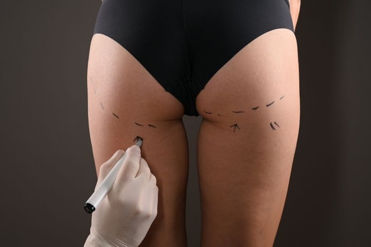 Elite Body Contouring in Northern Virginia