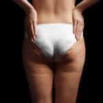 cellulite specialist tysons corner