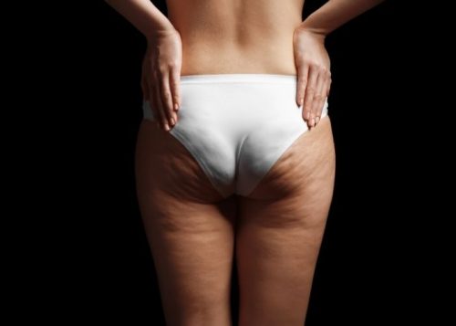 2 Great Treatments Performed by a Cellulite Specialist in Tysons Corner