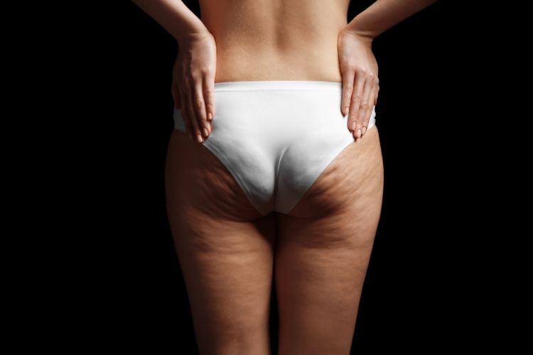 Cellulite Reduction in Northern Virginia