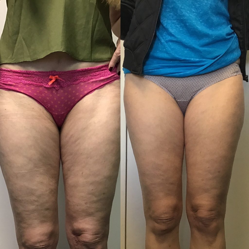 Cellulite Treatment Before-and-After Photos | Ultra Body Sculpt