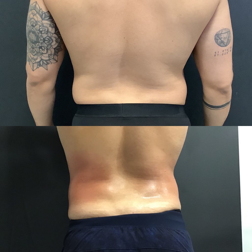 Male Lower Back - Elite Body Contouring in Northern Virginia