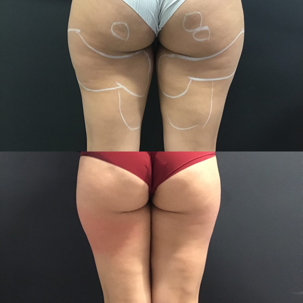 Cellulite Removal Before & After Photos