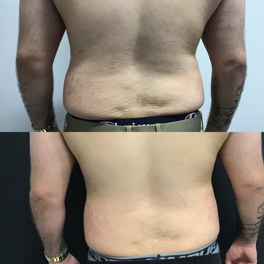 Male Lower Back - Elite Body Contouring in Northern Virginia