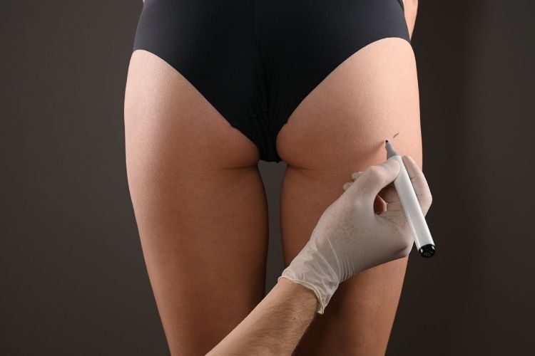 Best Brazilian Butt Lift Alternative, Emsculpt DC