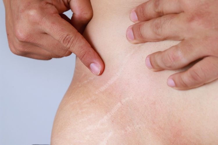 Are Stretch Marks Permanent?  Definitive Guide to Treatment Options