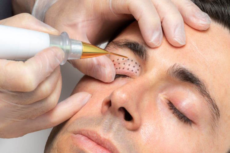 man getting treatment with plasma pen in Arlington