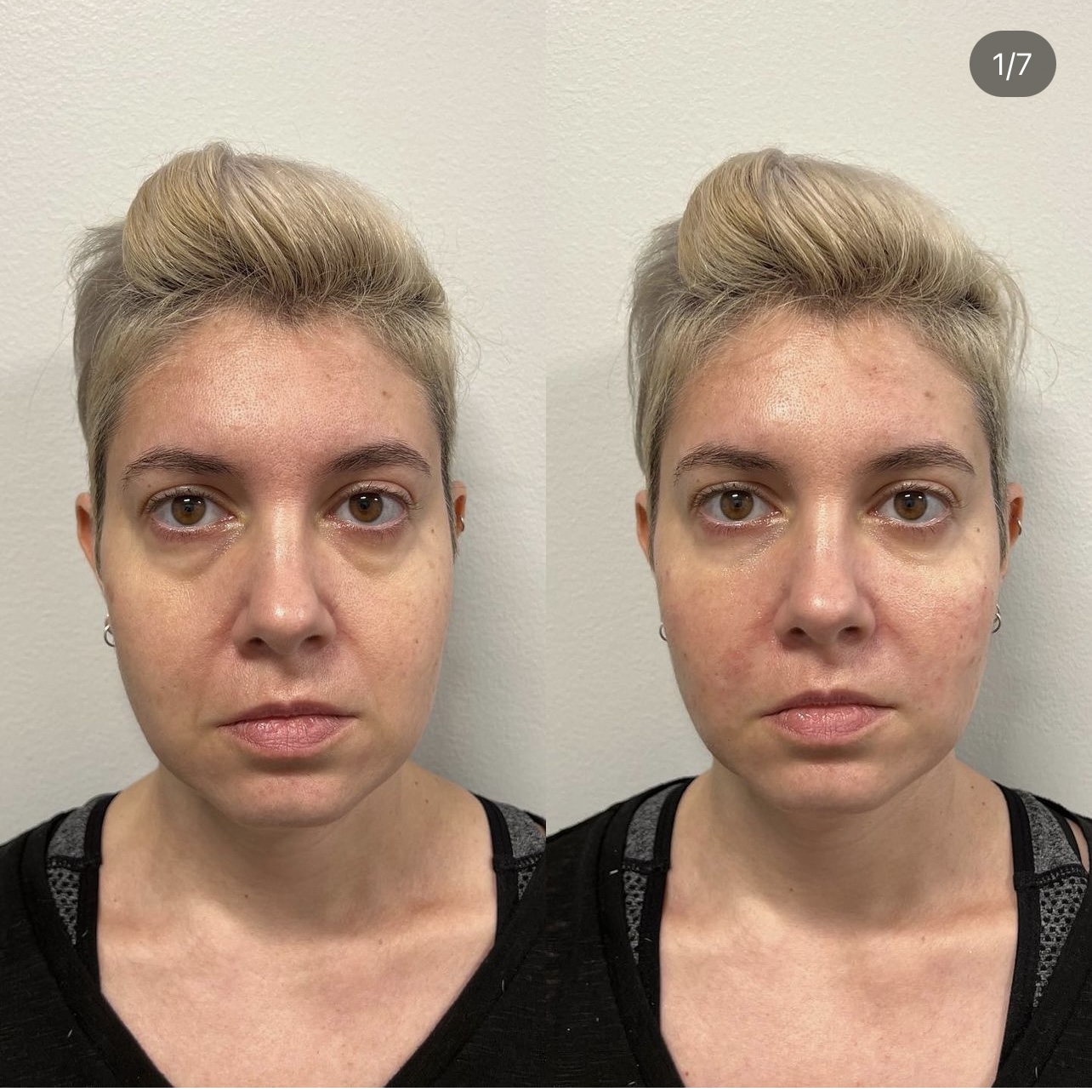 AntiAging Elite Body Contouring in Northern Virginia Ultra Body Sculpt