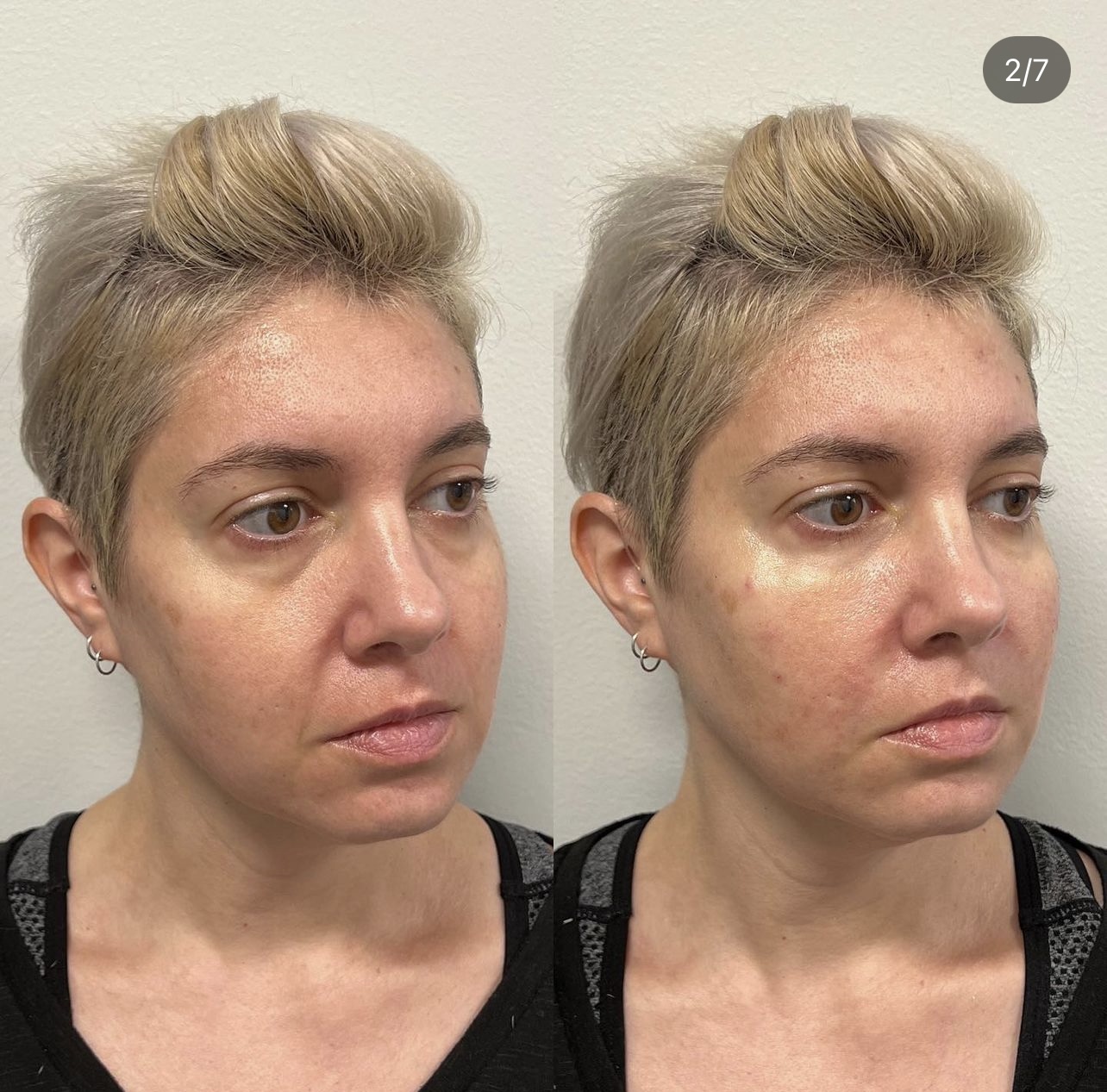 AntiAging Elite Body Contouring in Northern Virginia Ultra Body Sculpt