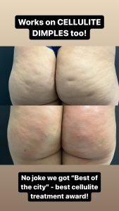 cellulite reduction Northern Virginia