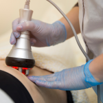 cellulite treatments mclean