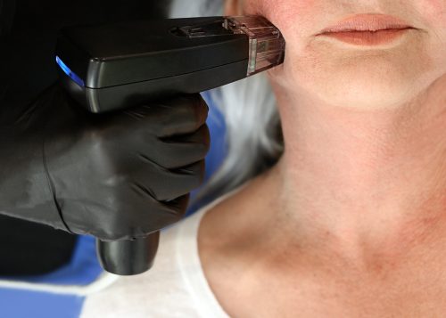 What Is the Best Non-Surgical Procedure to Tighten Skin Near Warrenton, VA?