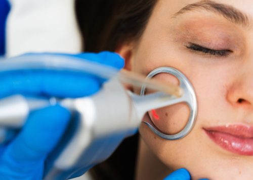 Traditional CO2 Laser Therapy vs CoolPeel in Northern Virginia