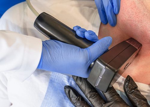 Treat Jowls in Arlington, VA, With Morpheus8 RF Microneedling