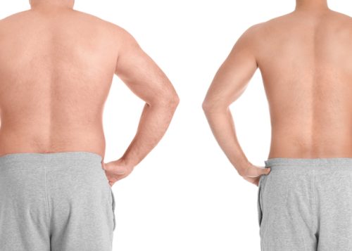 Morpheus8 for Men in Arlington, VA: Reduce Flank and Back Fat