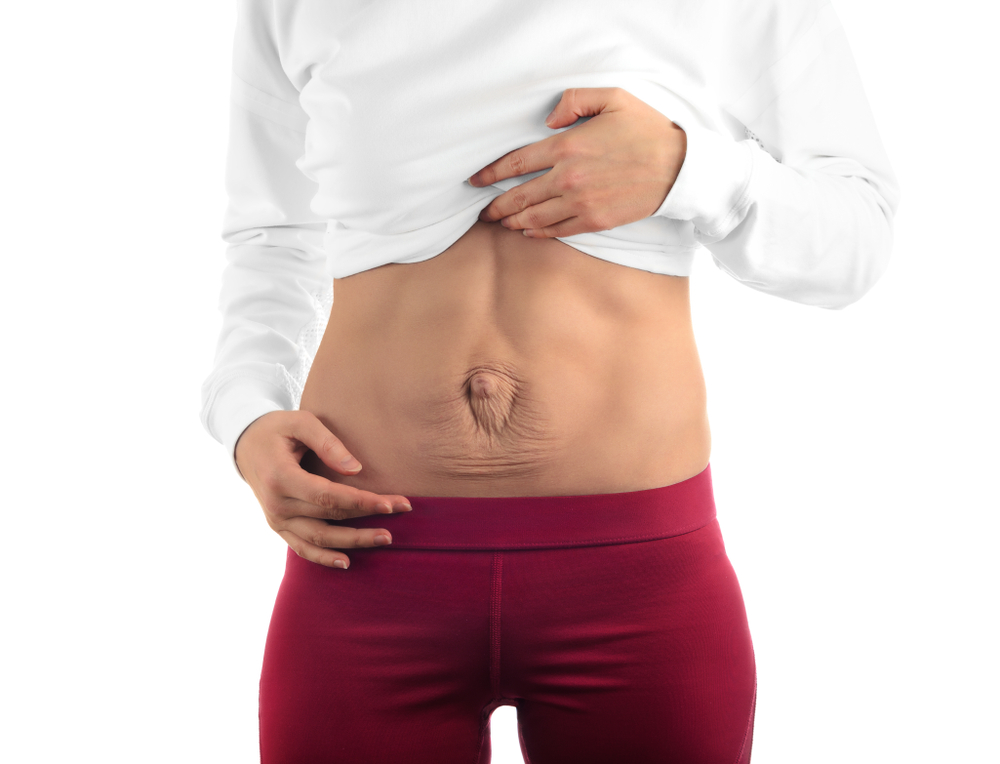 woman post-pregnancy dealing with diastasis recti in DC