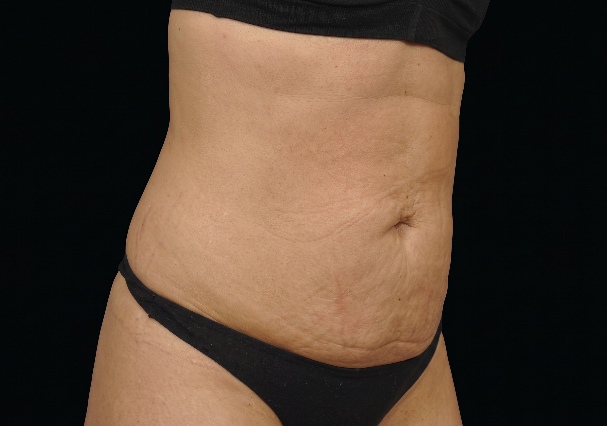 Emsculpt after