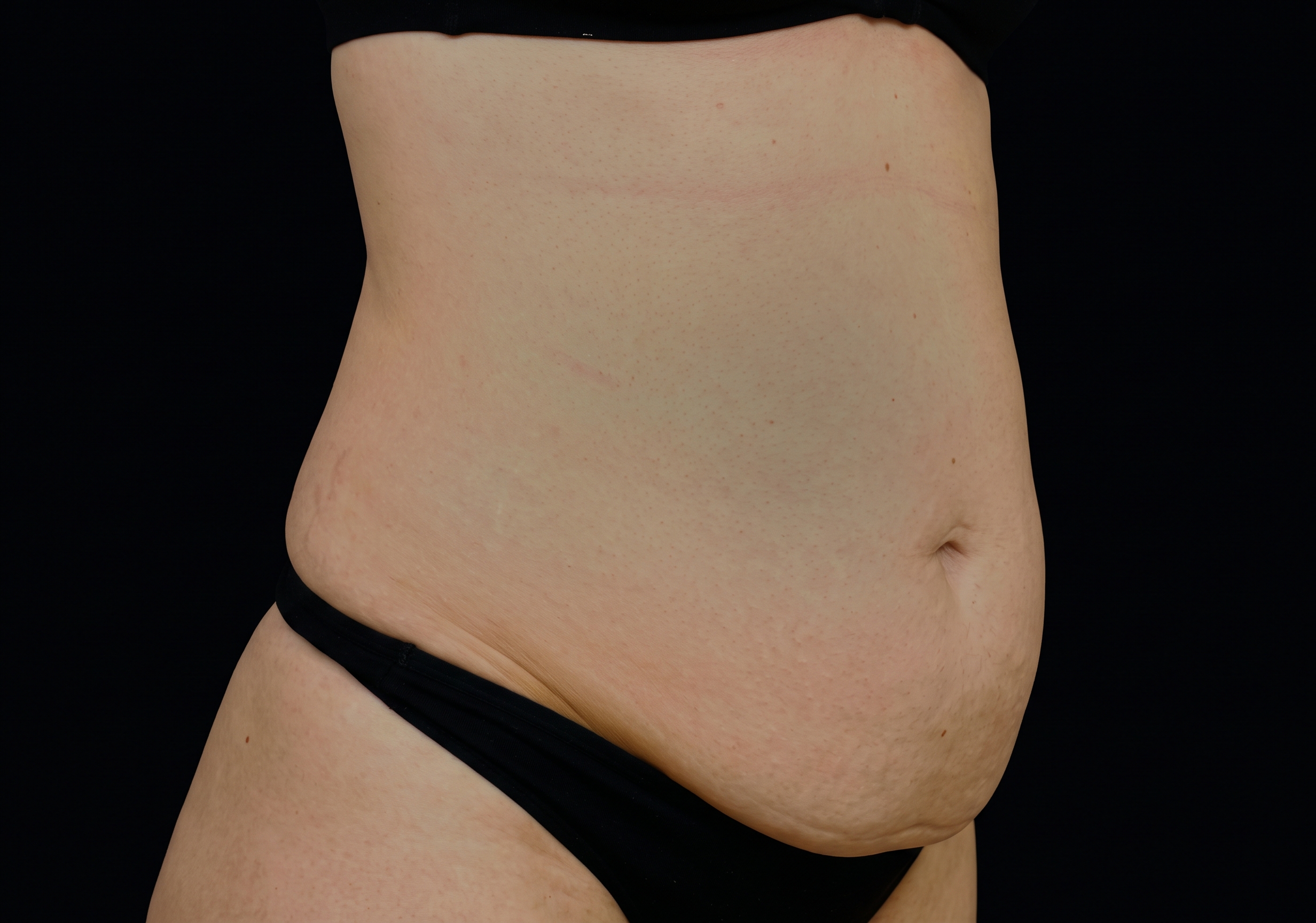 Emsculpt Before